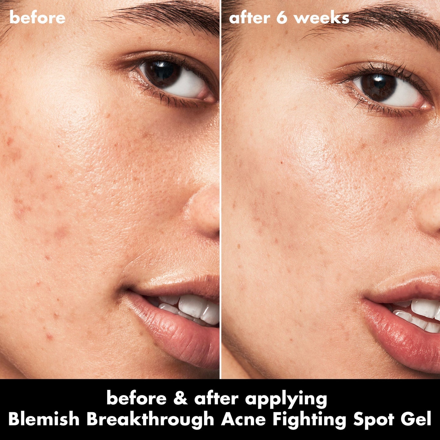 blemish-breakthrough-acne-fighting-spot-gel-h1 0326_EDU_BB_SpotGel_BA_ISABELLA.jpg