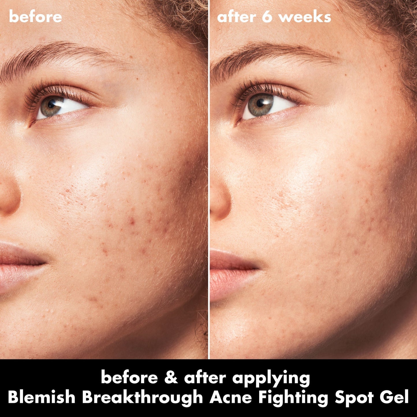blemish-breakthrough-acne-fighting-spot-gel-h1 0326_EDU_BB_SpotGel_BA_MARLEY.jpg