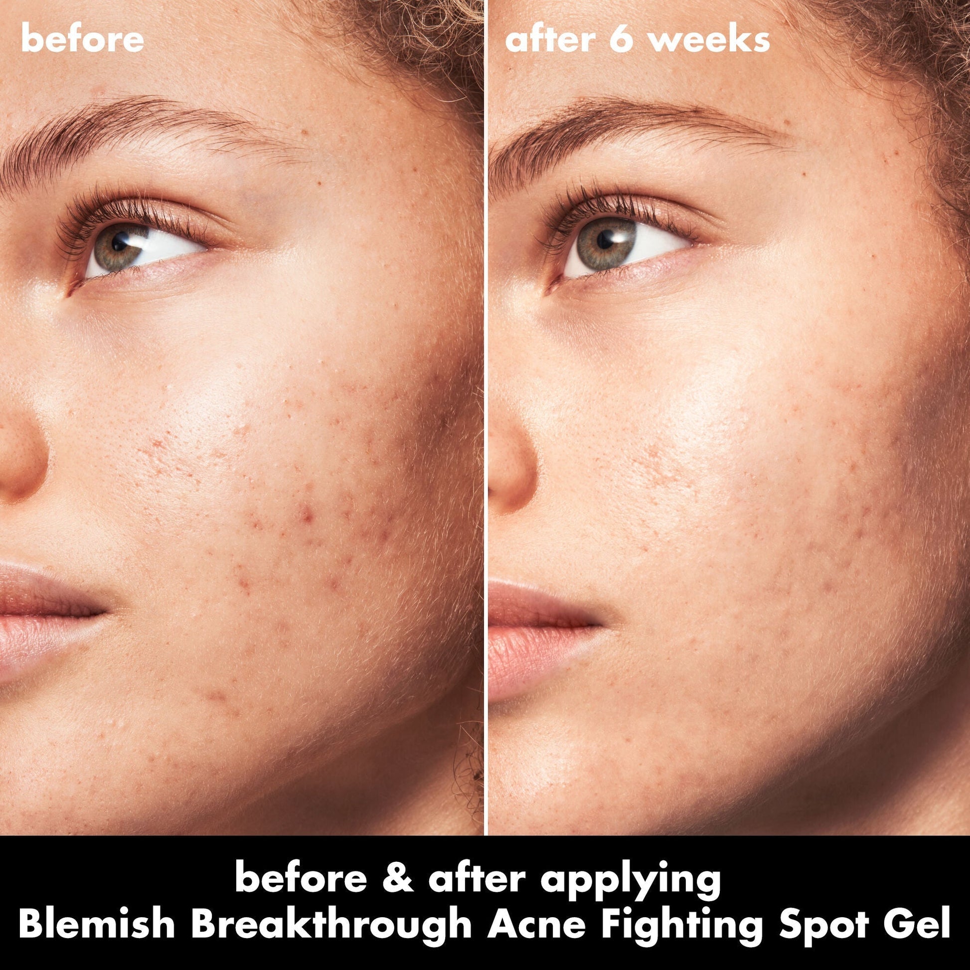 blemish-breakthrough-acne-fighting-spot-gel-h1 0326_EDU_BB_SpotGel_BA_MARLEY.jpg