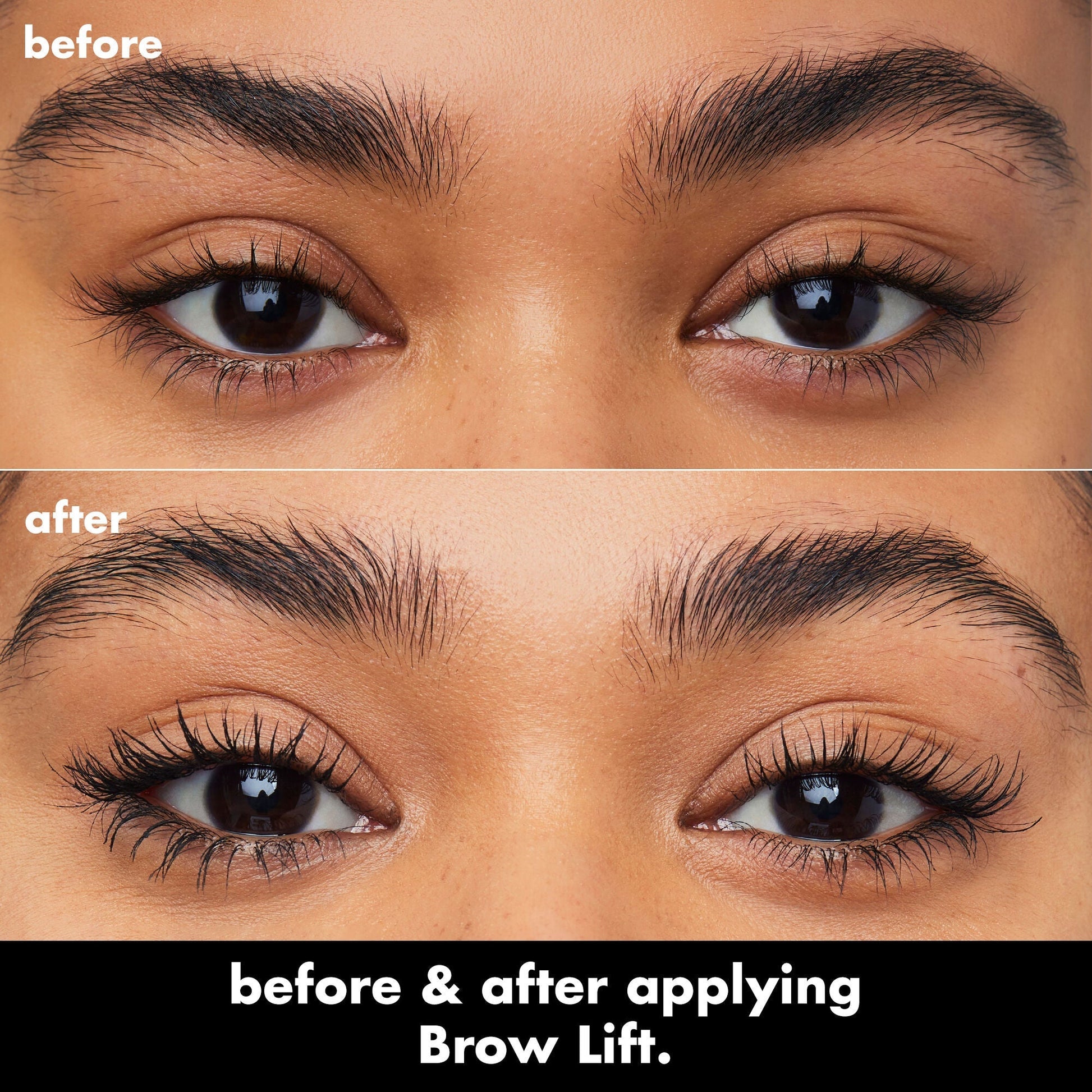 brow-lift-q0 0326_EDU_BrowLift_BA.jpg