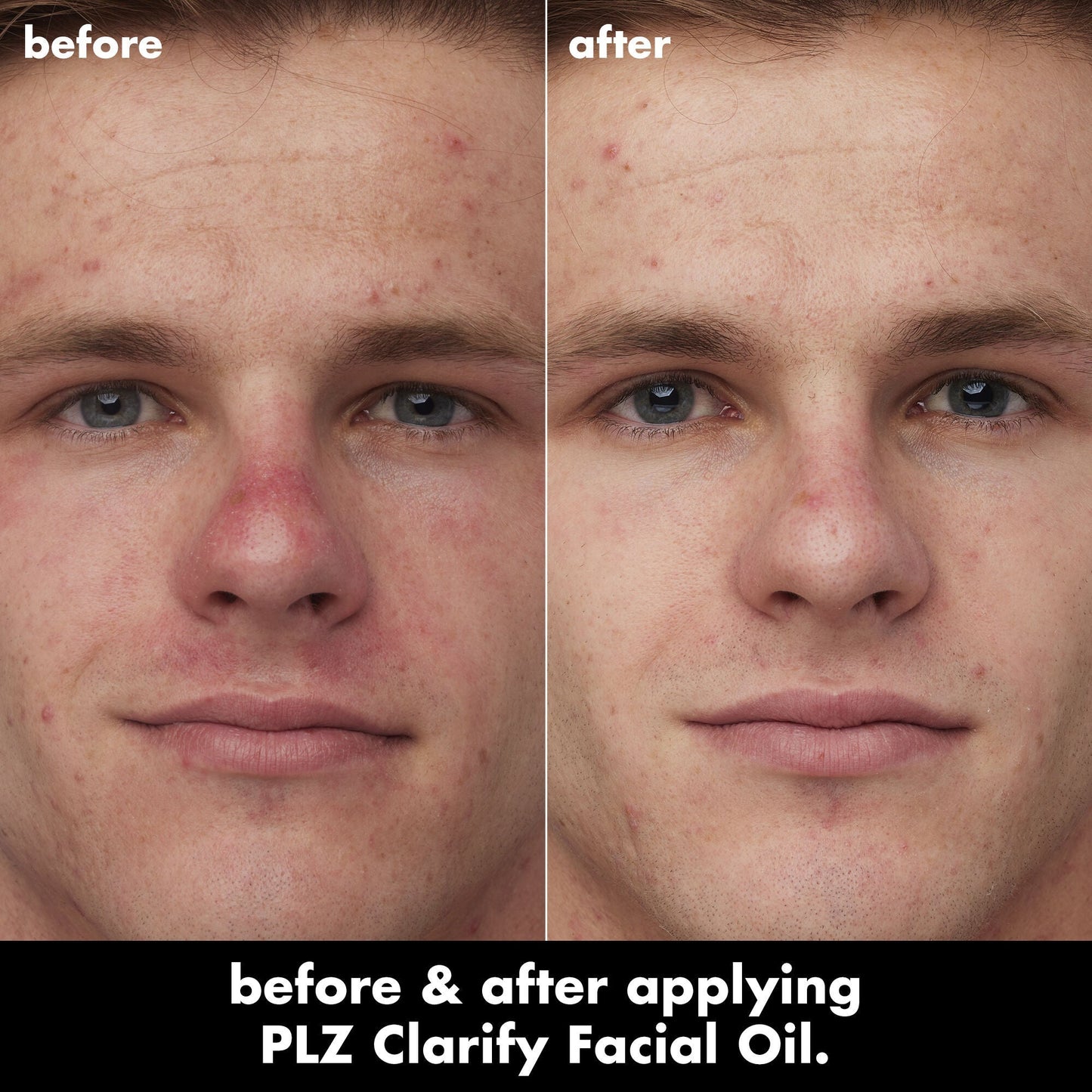 plz-clarify-facial-oil-y6 0326_EDU_PlzClarify_BA_Caleb.jpg