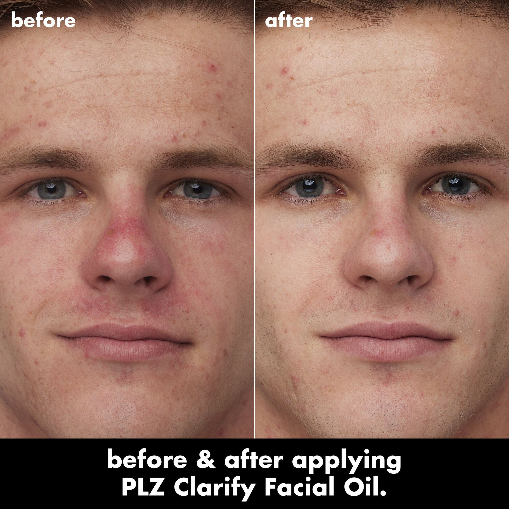 plz-clarify-facial-oil-y6 0326_EDU_PlzClarify_BA_Caleb.jpg