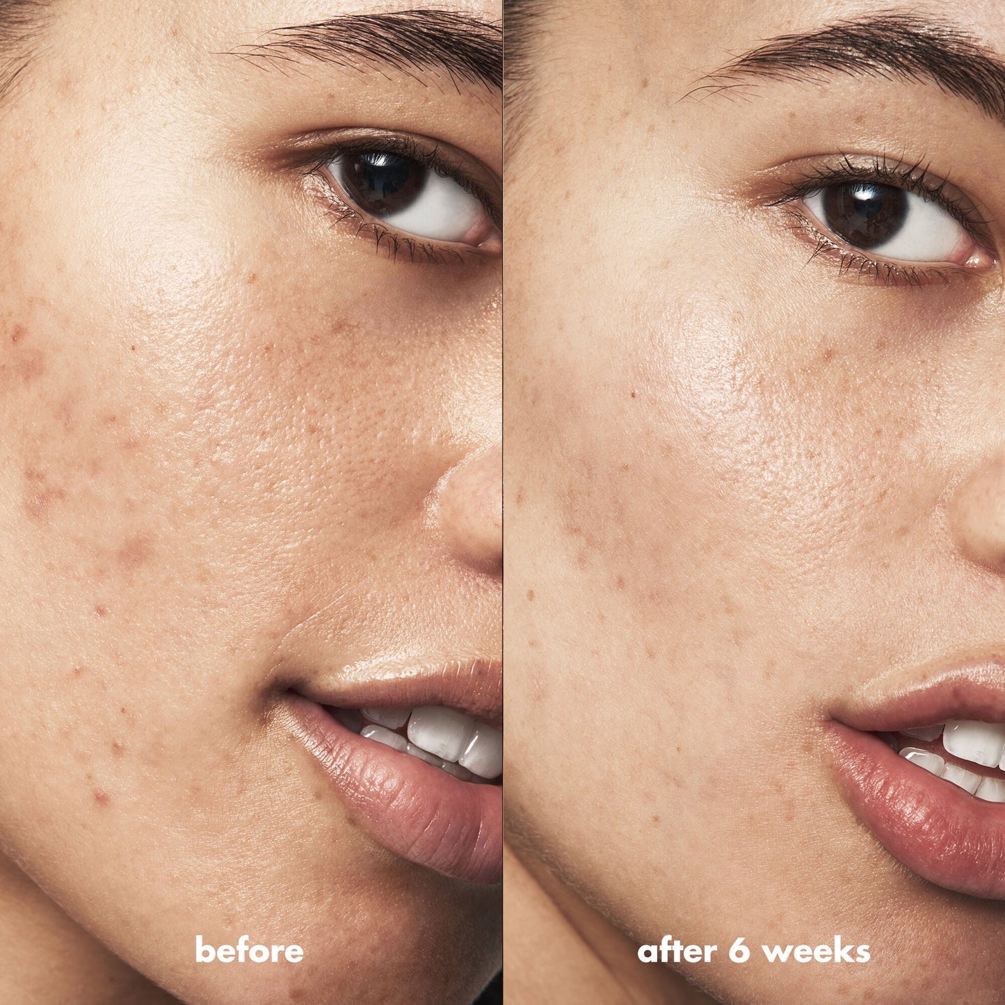 blemish-breakthrough-blemish-control-basics-kit-g6 Acne_PDP_Isabella_Before_After_0fcb9356-ae60-4e94-8953-6b1b2219dc49.jpg
