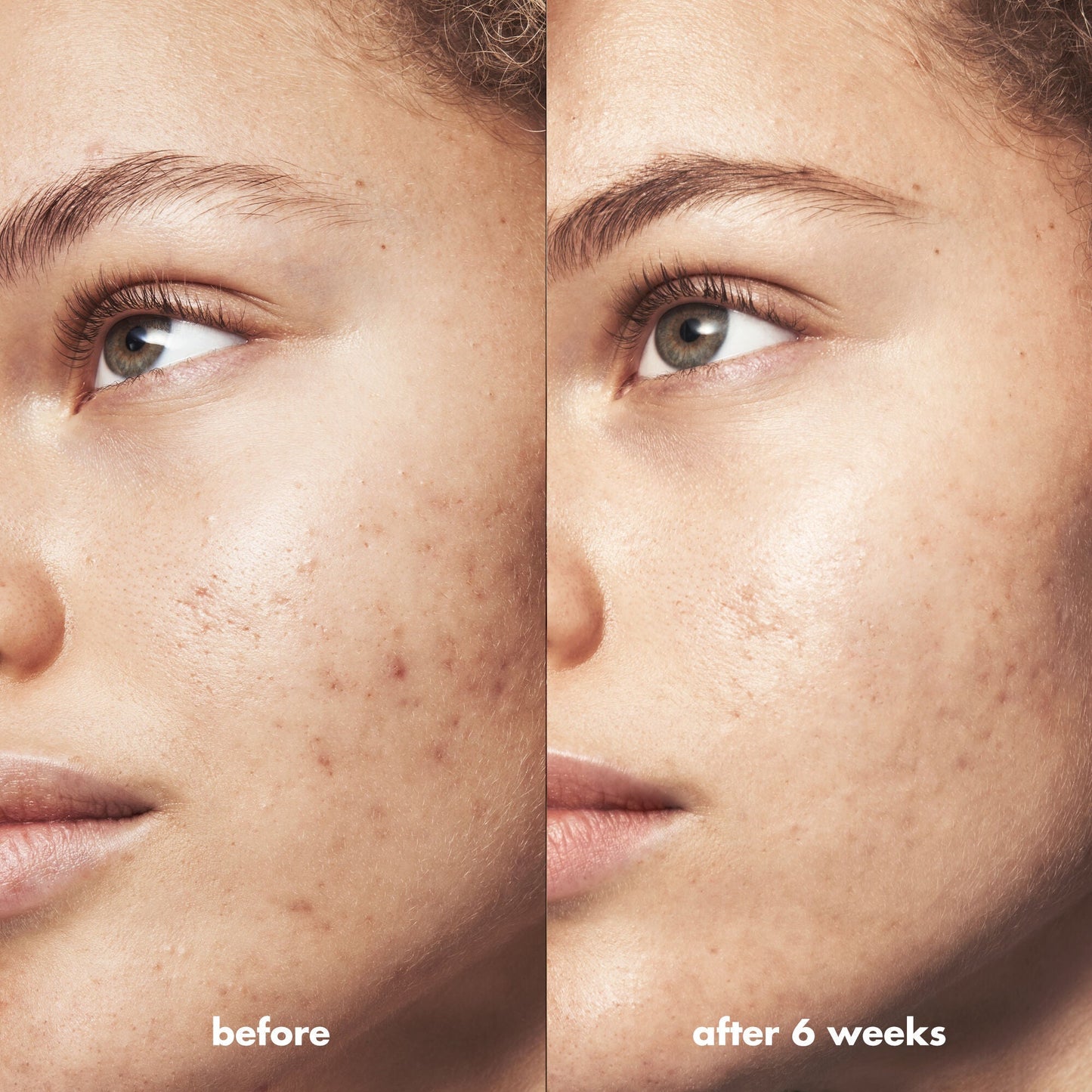 blemish-breakthrough-acne-calming-water-cream-mini-s5 Acne_PDP_Marley_Before_After_acf01478-a58b-47ce-99b5-2ef1dc022f9b.jpg
